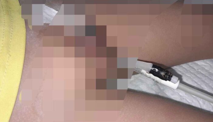 Tragis! Ikut Sunat Massal, Penis  Bocah Putus, Orang Tua Minta Pertanggung Jawaban se Adil-adilnya